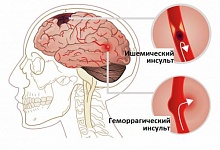 Скворцова предупредила молодежь, что инсульт теперь касается 20-30-летних